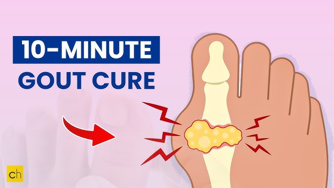 Gout Treatment